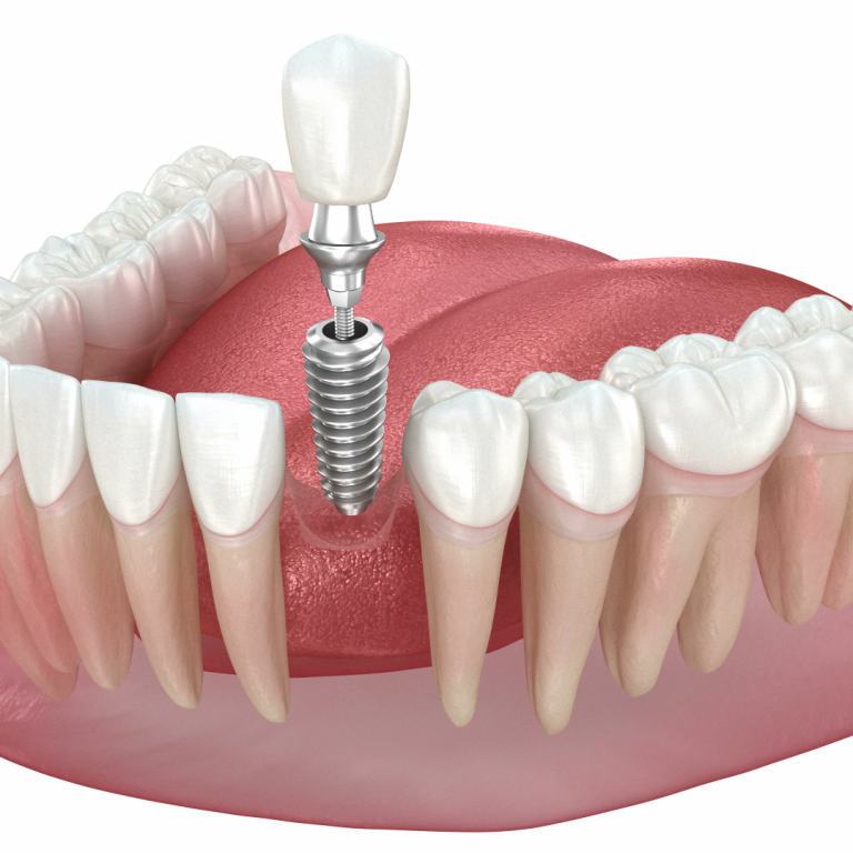 What Are the 3 Types of Dental Implants